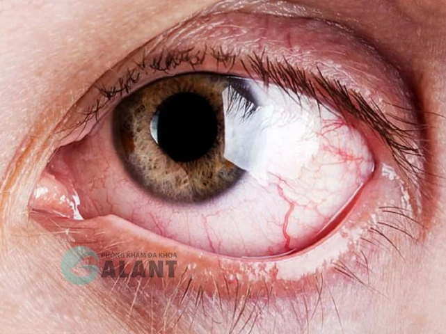 Cận cảnh mắt bị ảnh hưởng bởi ký sinh trùng sán chó