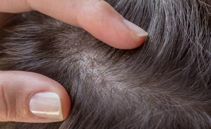Chân tóc có hạt trắng li ti