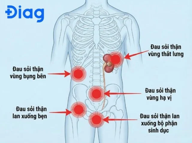 Cơn đau sỏi thận lan xuống vùng sinh dục nam giới