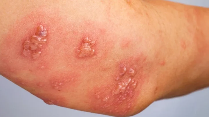 Hình ảnh giời leo giai đoạn mụn nước