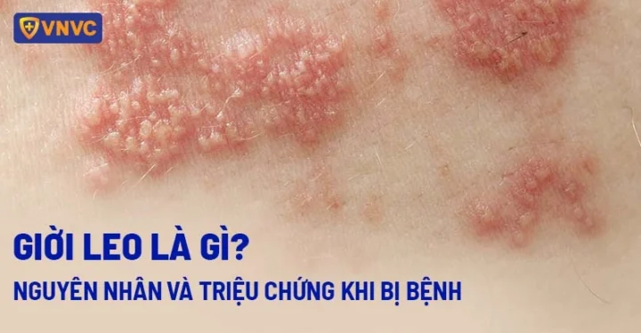 Hình ảnh minh họa bệnh giời leo