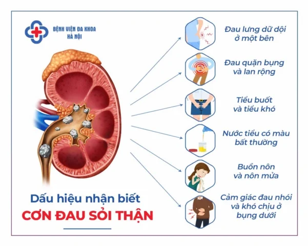 Hình ảnh minh họa sỏi thận trong thận