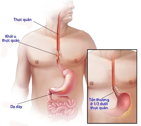 Hình ảnh minh họa vị trí thực quản trong cơ thể