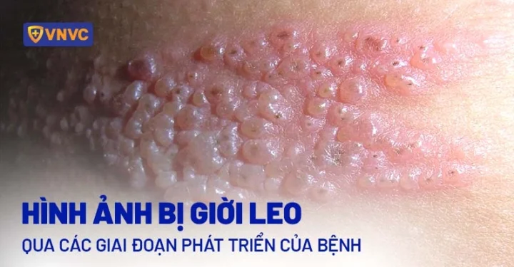 Hình ảnh mụn nước đặc trưng của giời leo
