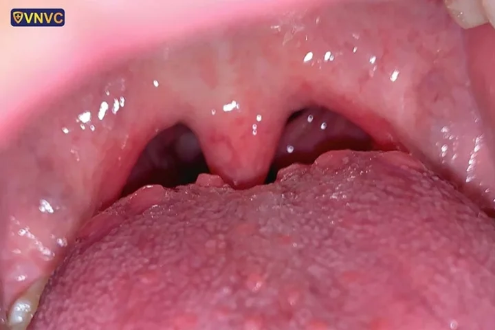 Hình ảnh sùi mào gà ở lưỡi với các nốt sùi nhỏ, màu hồng hoặc trắng đục
