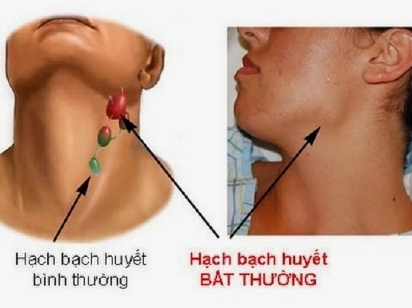 Vị trí hạch bạch huyết ở cổ: Nhận biết và hiểu rõ Minh họa vị trí hạch bạch huyết ở cổ