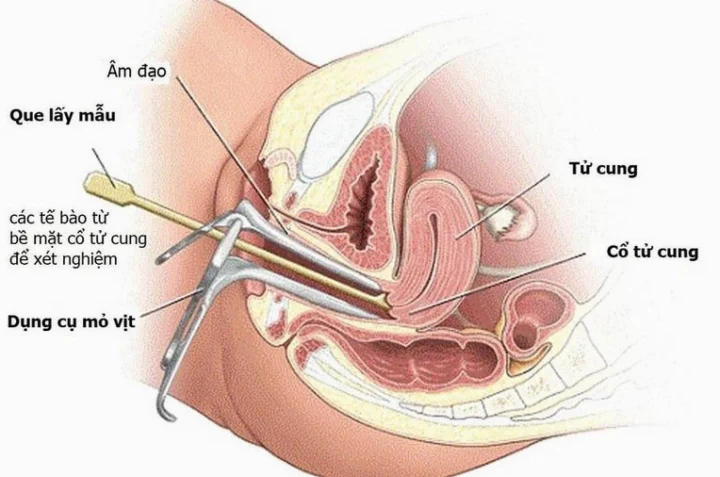 Mỏ Vịt Khám Phụ Khoa: Tất Tần Tật Thông Tin Cần Biết 2026