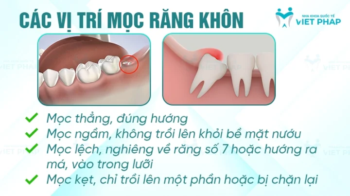 Răng khôn mọc ở đâu? Vị trí và những điều cần biết