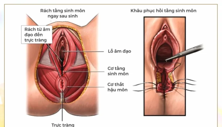 Tầng Sinh Môn: Kiến Thức Chuyên Sâu Cho Sức Khỏe Phụ Nữ 2026