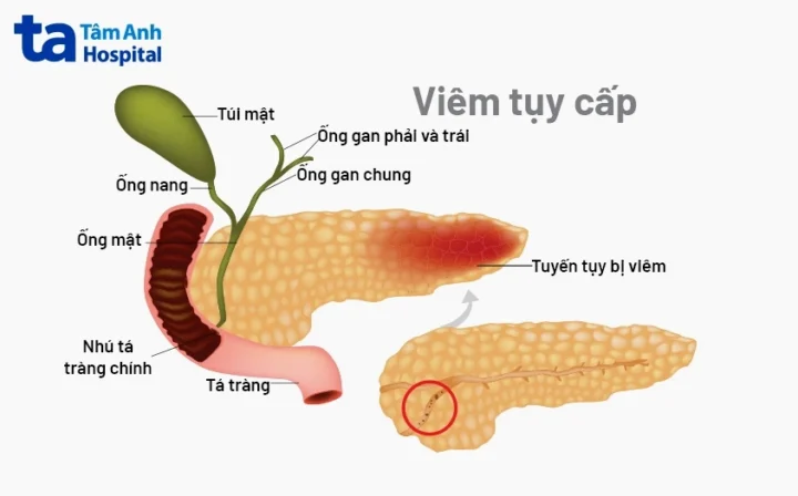 Tuyến Tụy Là Gì? Chức Năng, Vai Trò và Bệnh Lý Liên Quan