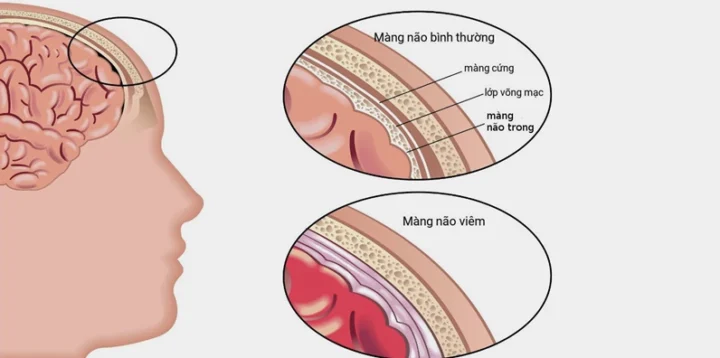 Viêm màng não là gì? Nguyên nhân, triệu chứng và cách phòng ngừa 2026 Vi khuẩn gây viêm màng não