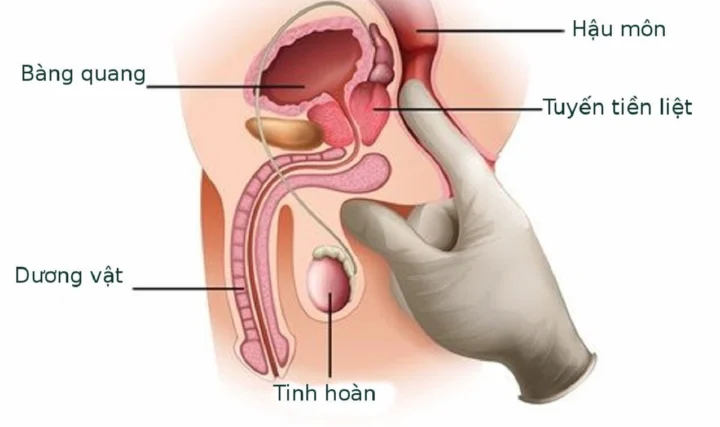 Viêm niệu đạo