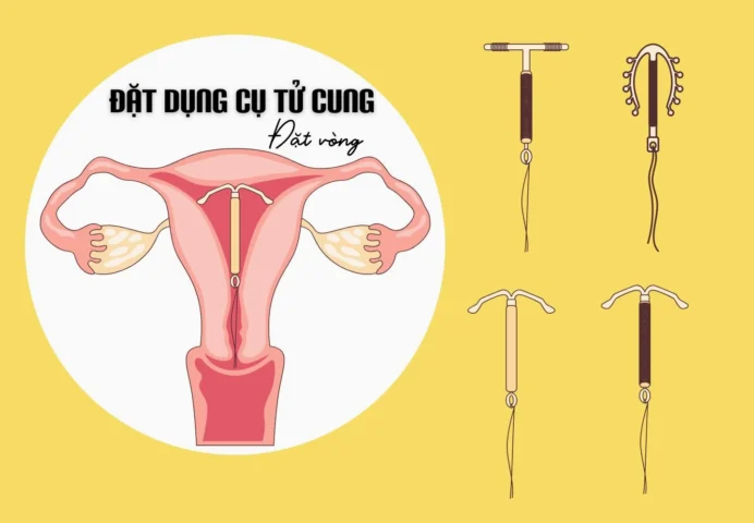 Vòng tránh thai hình chữ T